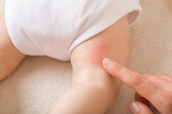 Dermatita de scutec – cauze, tratament şi prevenţie