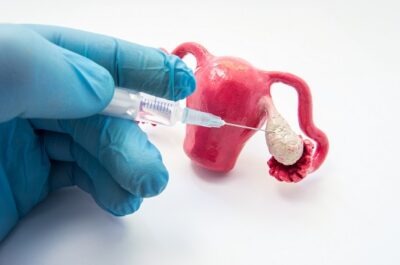 Cum funcţionează terapia de stimulare ovariană