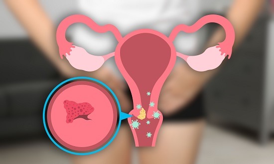 Negi genitali – cauze, simptome, diagnostic, tratament şi prevenţie