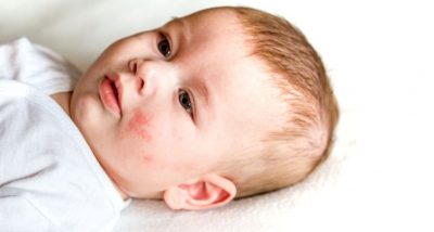 Tot ce trebuie sa stii despre iritatiile pielii la bebelusi
