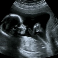 Monitorizarea fetala in uter-cardiotocografia