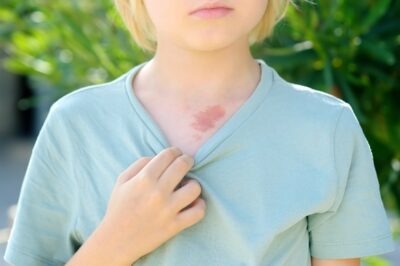 Hemangiom – cauze, diagnostic şi tratament