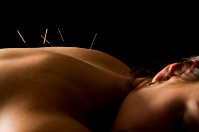Despre acupunctură și rolul ei în tratarea infertilității