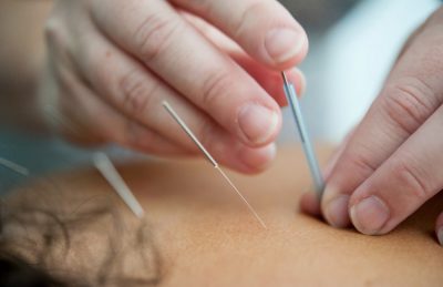 Studiile confirmă: acupunctura îmbunătățește viața sexuală