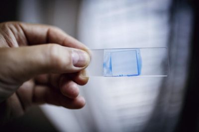 Candidoza (Candida Albicans): ce este, de ce apare, riscuri și tratament