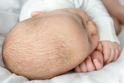 Sfaturi pentru îngrijirea pielii uscate sau atopice la bebeluşi