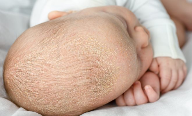 Sfaturi pentru îngrijirea pielii uscate sau atopice la bebeluşi