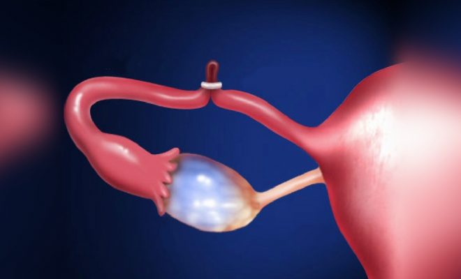 Legarea trompelor uterine: beneficii, riscuri, complicatii