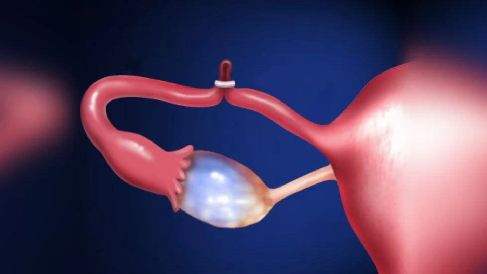 Legarea trompelor uterine: beneficii, riscuri, complicatii